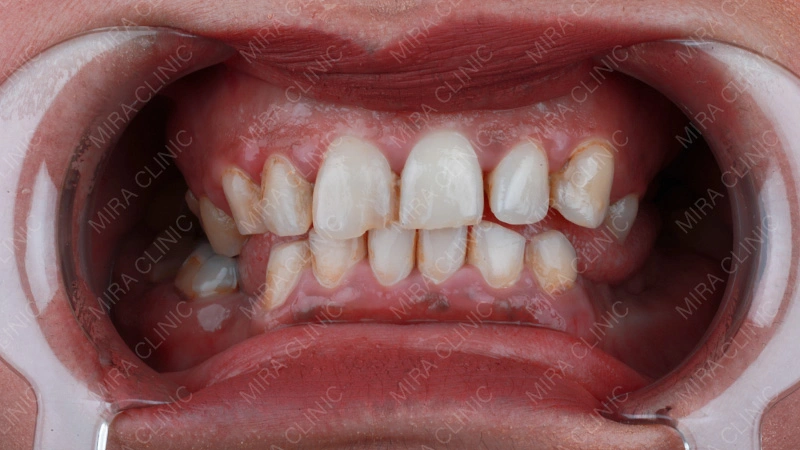 Weak Teeth case